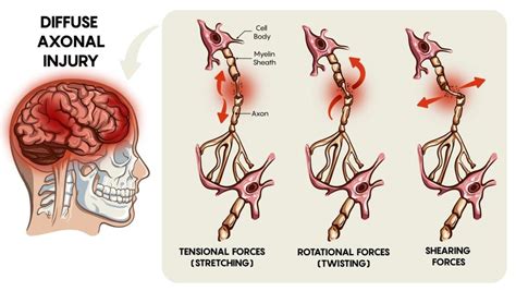 2. Diffuse axonal injury. During traumatic brain injury, axons may be ...